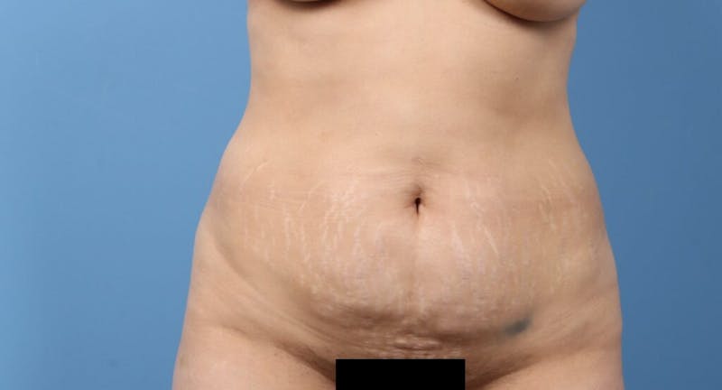 Brazilian Butt Lift (BBL) Before & After Gallery - Patient 189611 - Image 3