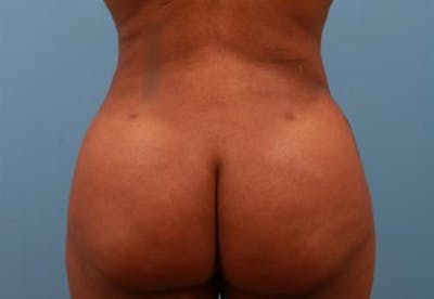 Brazilian Butt Lift (BBL) Before & After Gallery - Patient 230337 - Image 2