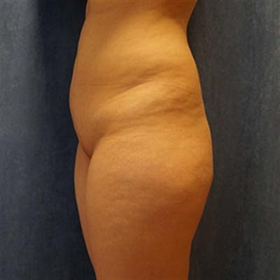 Brazilian Butt Lift (BBL) Before & After Gallery - Patient 251521 - Image 1