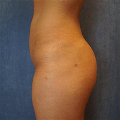 Brazilian Butt Lift (BBL) Before & After Gallery - Patient 251521 - Image 2