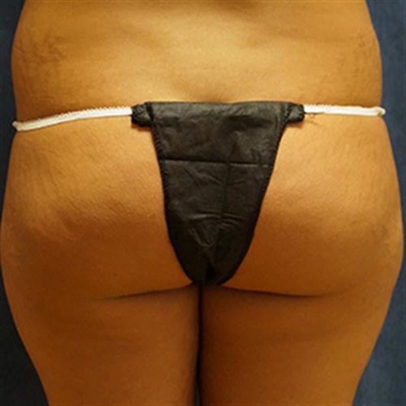 Brazilian Butt Lift (BBL) Before & After Gallery - Patient 108051 - Image 1