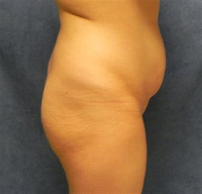 Brazilian Butt Lift (BBL) Before & After Gallery - Patient 342588 - Image 1
