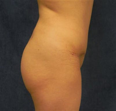 Brazilian Butt Lift (BBL) Before & After Gallery - Patient 342588 - Image 2