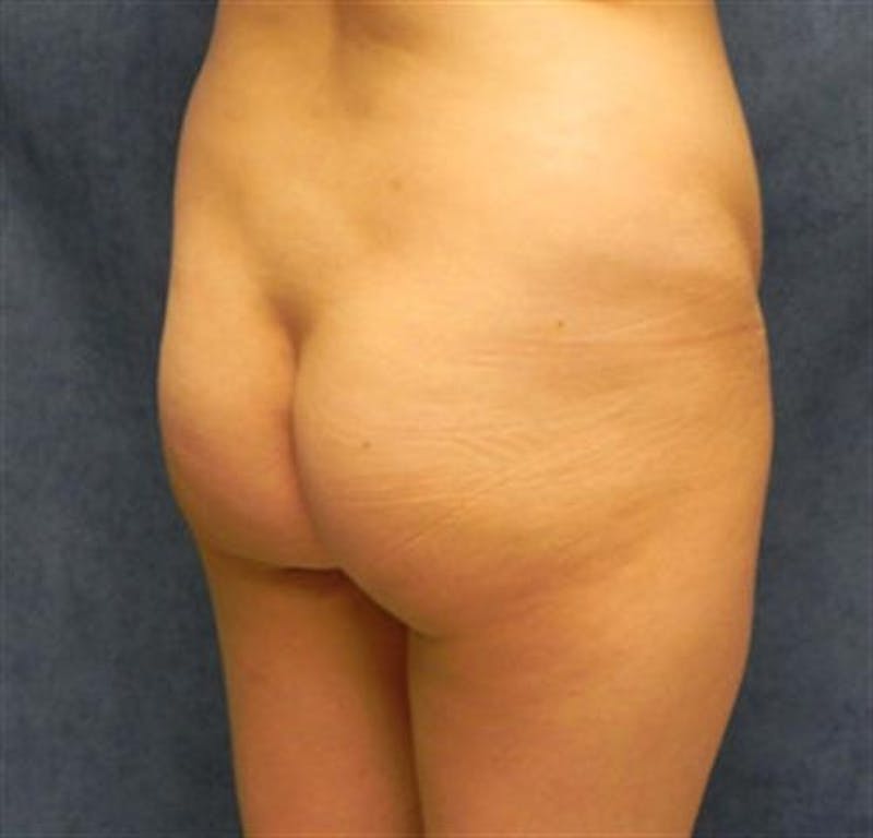 Brazilian Butt Lift (BBL) Before & After Gallery - Patient 342588 - Image 3
