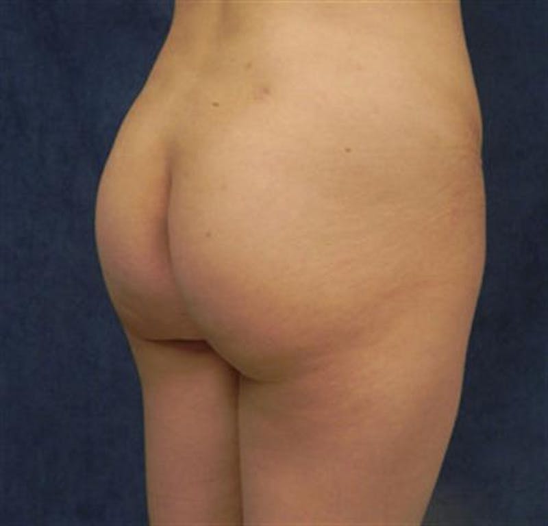 Brazilian Butt Lift (BBL) Before & After Gallery - Patient 342588 - Image 4
