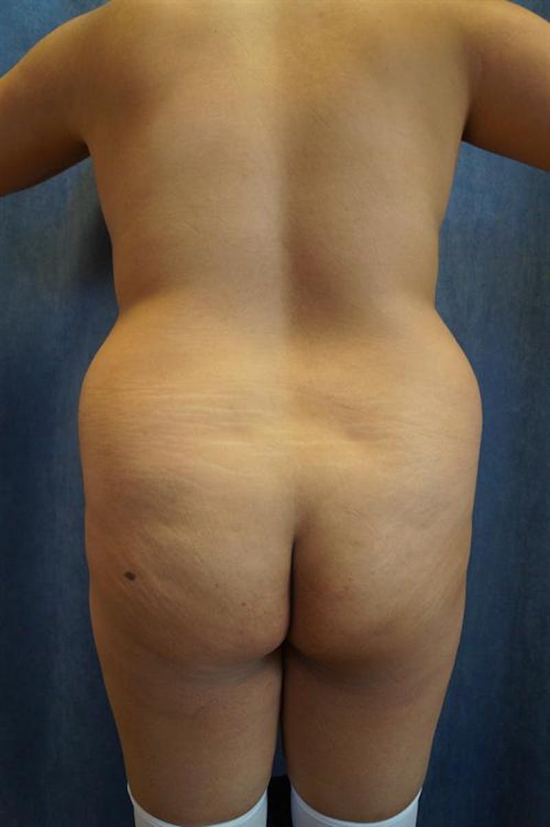 Brazilian Butt Lift (BBL) Before & After Gallery - Patient 416720 - Image 1