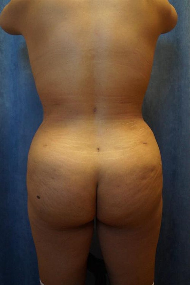 Brazilian Butt Lift (BBL) Before & After Gallery - Patient 416720 - Image 2