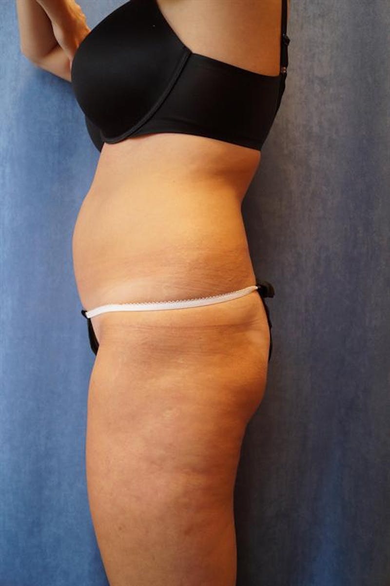 Brazilian Butt Lift (BBL) Before & After Gallery - Patient 688267 - Image 1