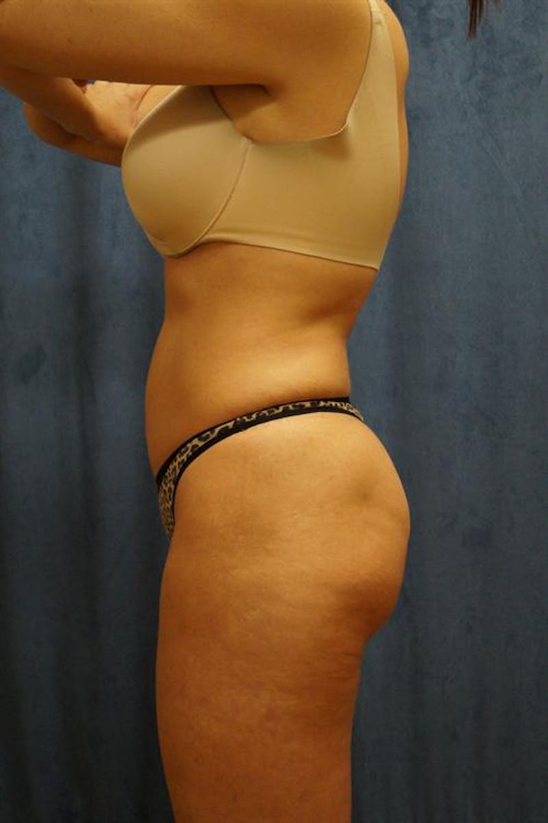 Brazilian Butt Lift (BBL) Before & After Gallery - Patient 688267 - Image 2