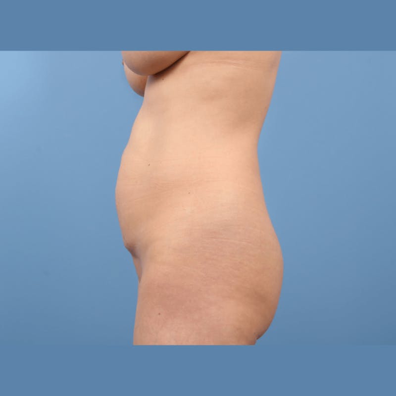 Liposuction Before & After Gallery - Patient 290652 - Image 5