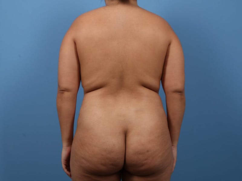 Liposuction Before & After Gallery - Patient 321511 - Image 1