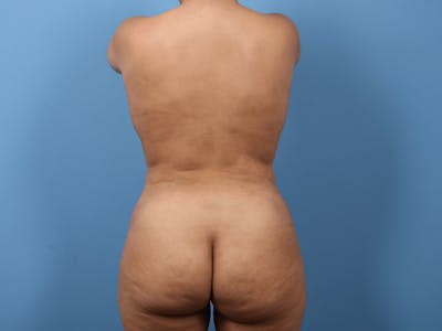 Liposuction Before & After Gallery - Patient 321511 - Image 2