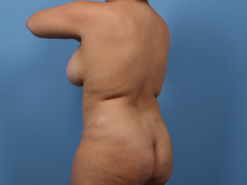 Liposuction Before & After Gallery - Patient 321511 - Image 3