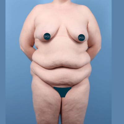 Liposuction Before & After Gallery - Patient 326936 - Image 1
