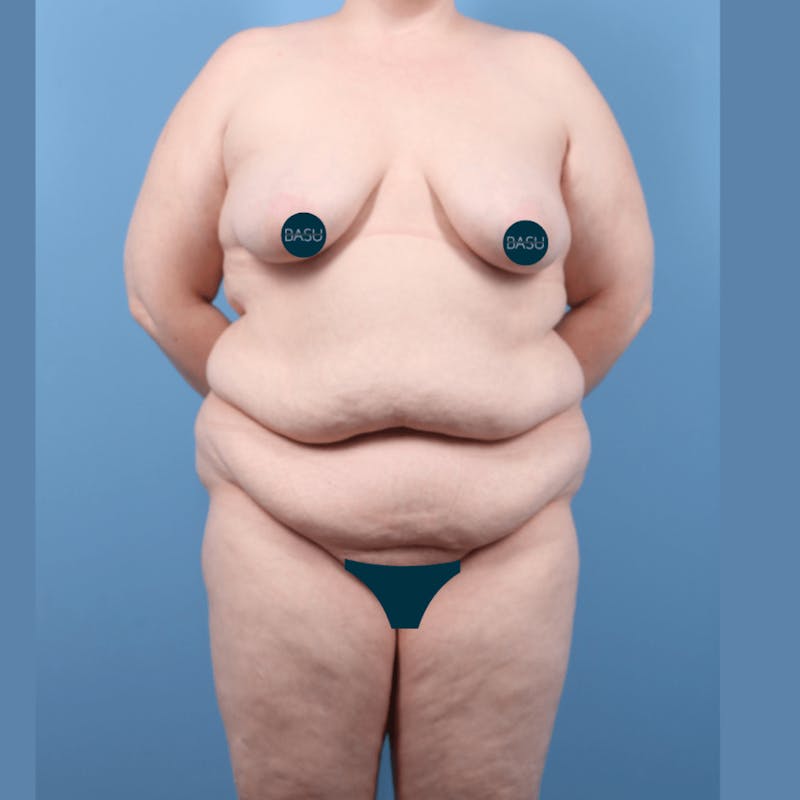 Liposuction Before & After Gallery - Patient 326936 - Image 1
