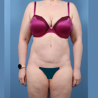 Liposuction Before & After Gallery - Patient 326936 - Image 2