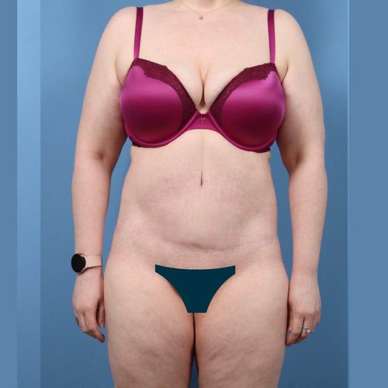 Liposuction Before & After Gallery - Patient 326936 - Image 2