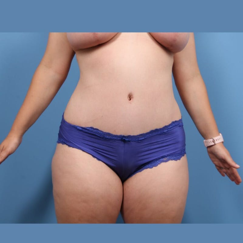 Liposuction Before & After Gallery - Patient 160890 - Image 2