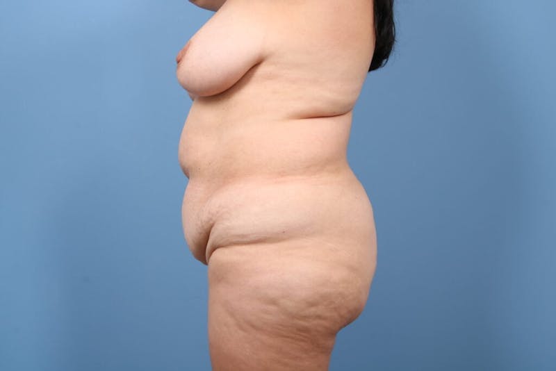 Liposuction Before & After Gallery - Patient 659620 - Image 5