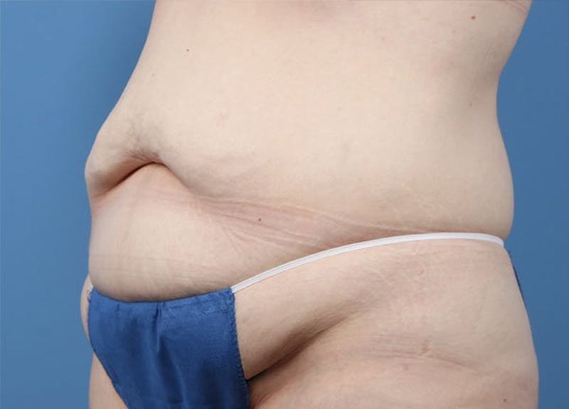 Liposuction Before & After Gallery - Patient 359382 - Image 3