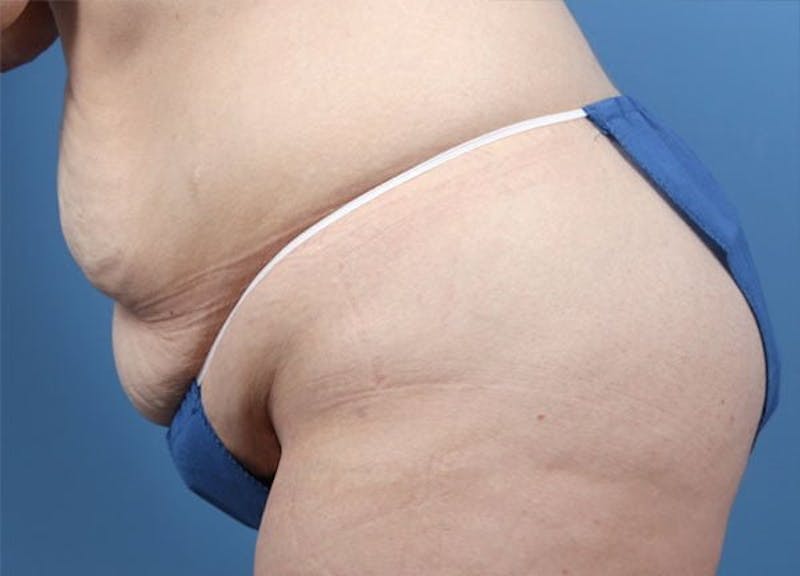 Liposuction Before & After Gallery - Patient 359382 - Image 5