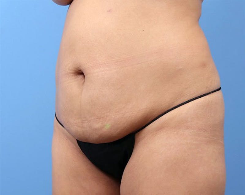 Liposuction Before & After Gallery - Patient 122149 - Image 3