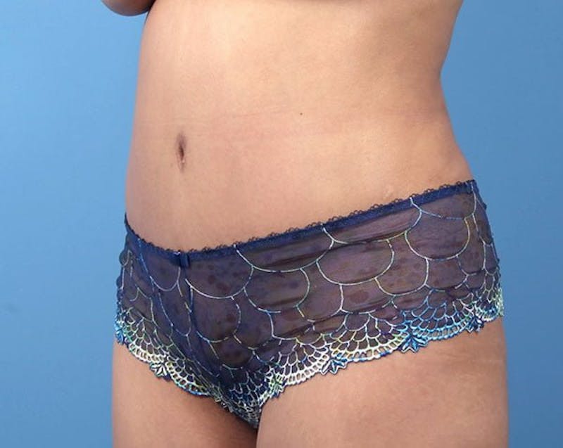 Liposuction Before & After Gallery - Patient 122149 - Image 4