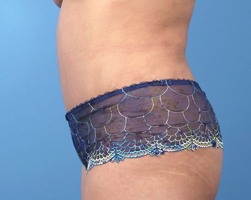 Liposuction Before & After Gallery - Patient 122149 - Image 6