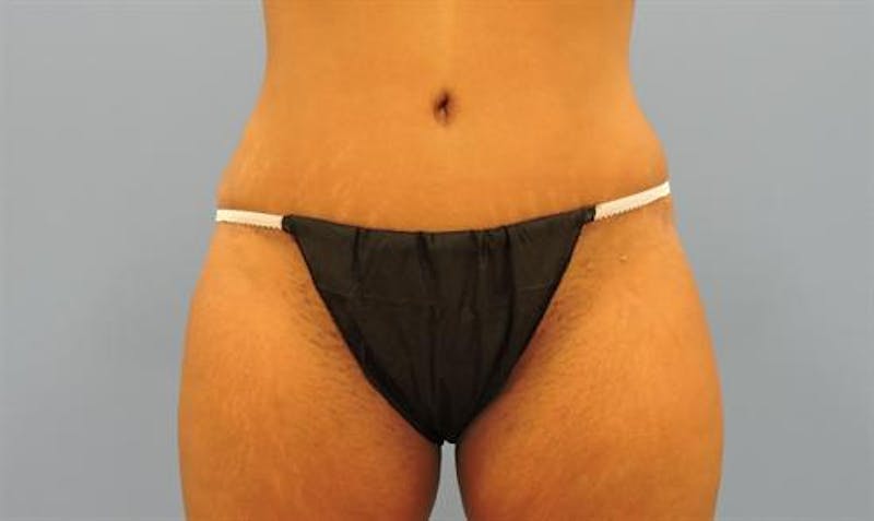 Liposuction Before & After Gallery - Patient 309324 - Image 2