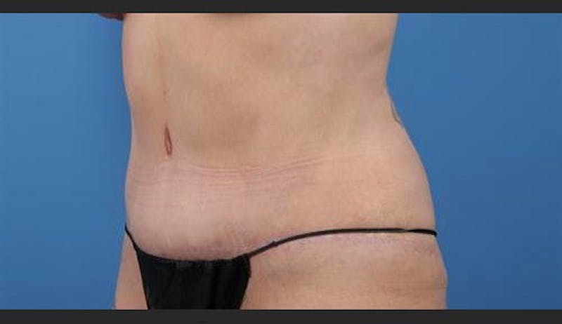 Liposuction Before & After Gallery - Patient 195624 - Image 4