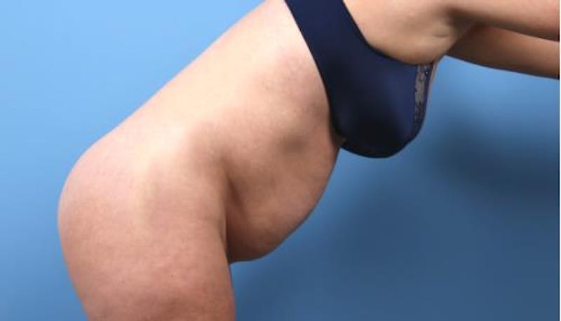 Liposuction Before & After Gallery - Patient 167560 - Image 1