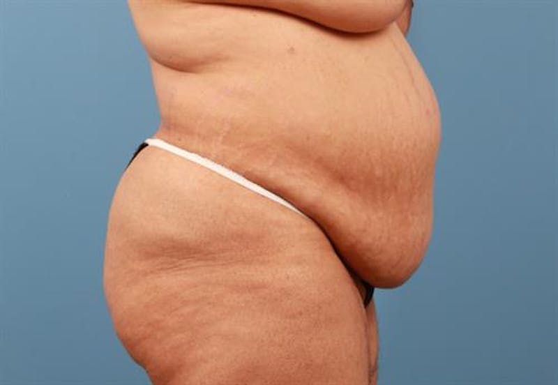 Liposuction Before & After Gallery - Patient 309904 - Image 3