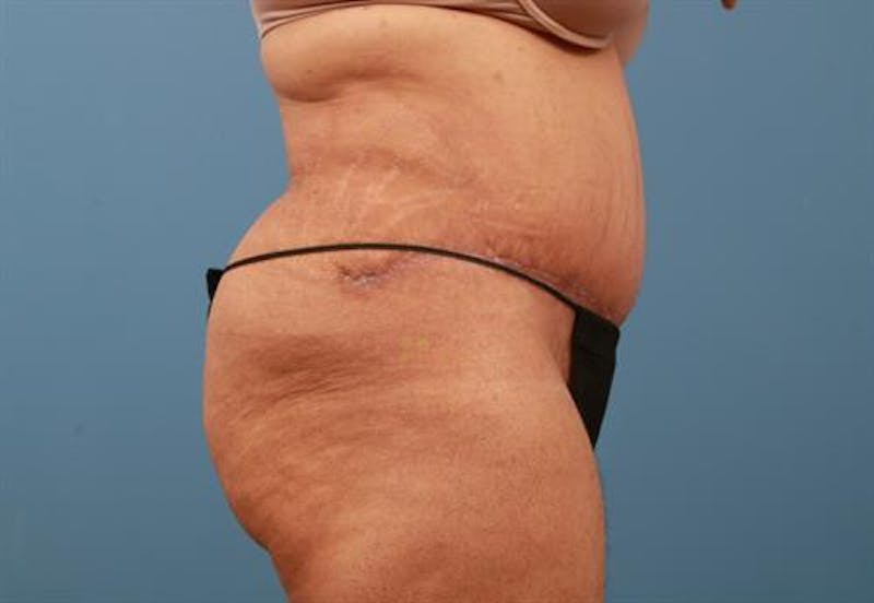 Liposuction Before & After Gallery - Patient 309904 - Image 4