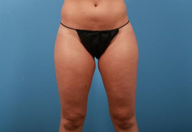 Liposuction Before & After Gallery - Patient 276004 - Image 3