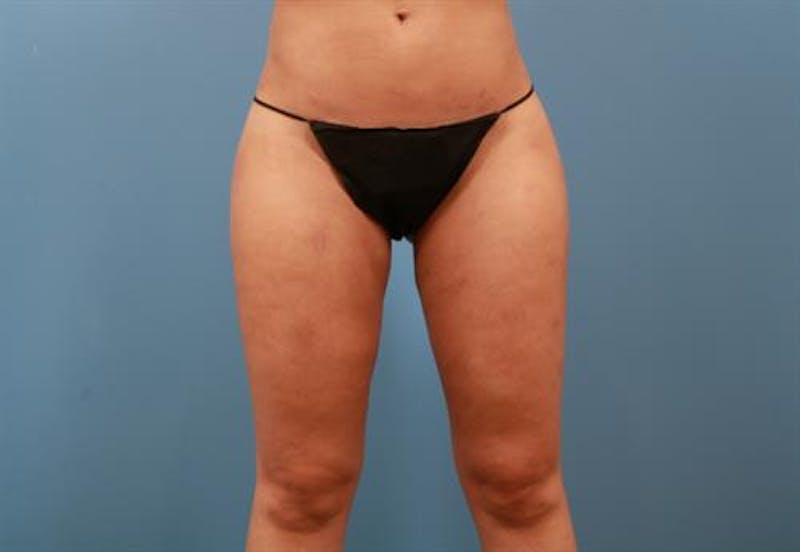 Liposuction Before & After Gallery - Patient 276004 - Image 4