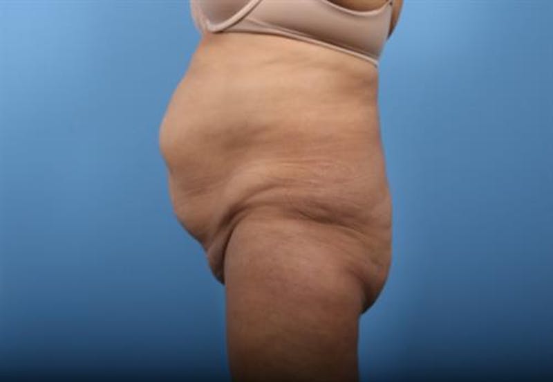 Liposuction Before & After Gallery - Patient 329004 - Image 5