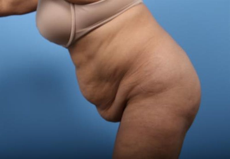 Liposuction Before & After Gallery - Patient 329004 - Image 7
