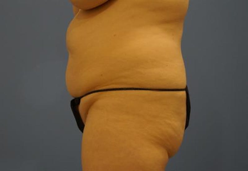 Liposuction Before & After Gallery - Patient 283159 - Image 5