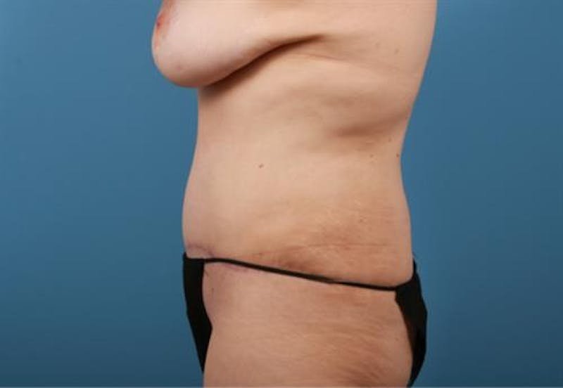 Liposuction Before & After Gallery - Patient 283159 - Image 6