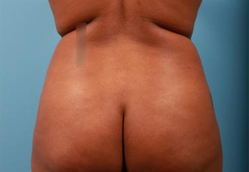 Liposuction Before & After Gallery - Patient 378408 - Image 1