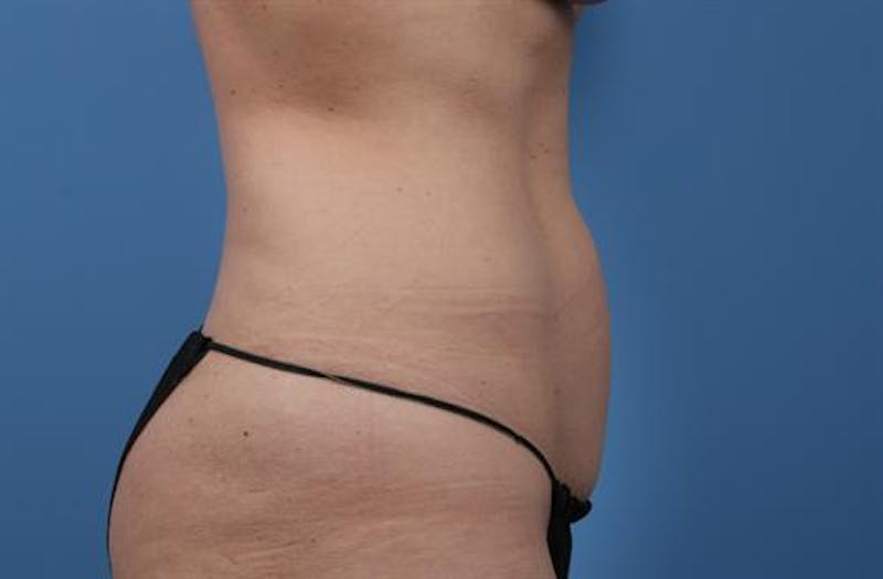 Liposuction Before & After Gallery - Patient 357389 - Image 1