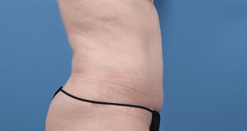 Liposuction Before & After Gallery - Patient 261161 - Image 4