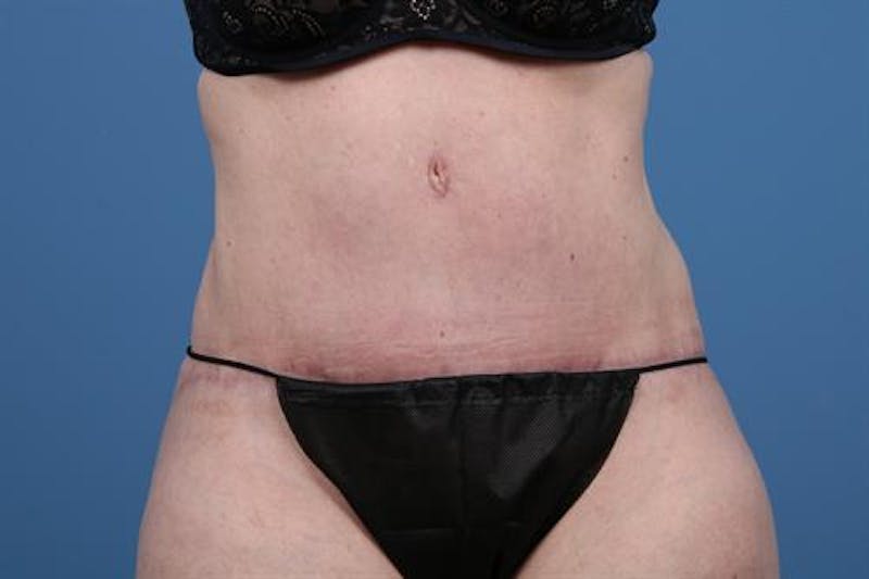 Liposuction Before & After Gallery - Patient 267125 - Image 2