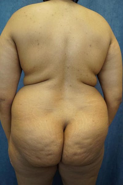 Liposuction Before & After Gallery - Patient 161229 - Image 1