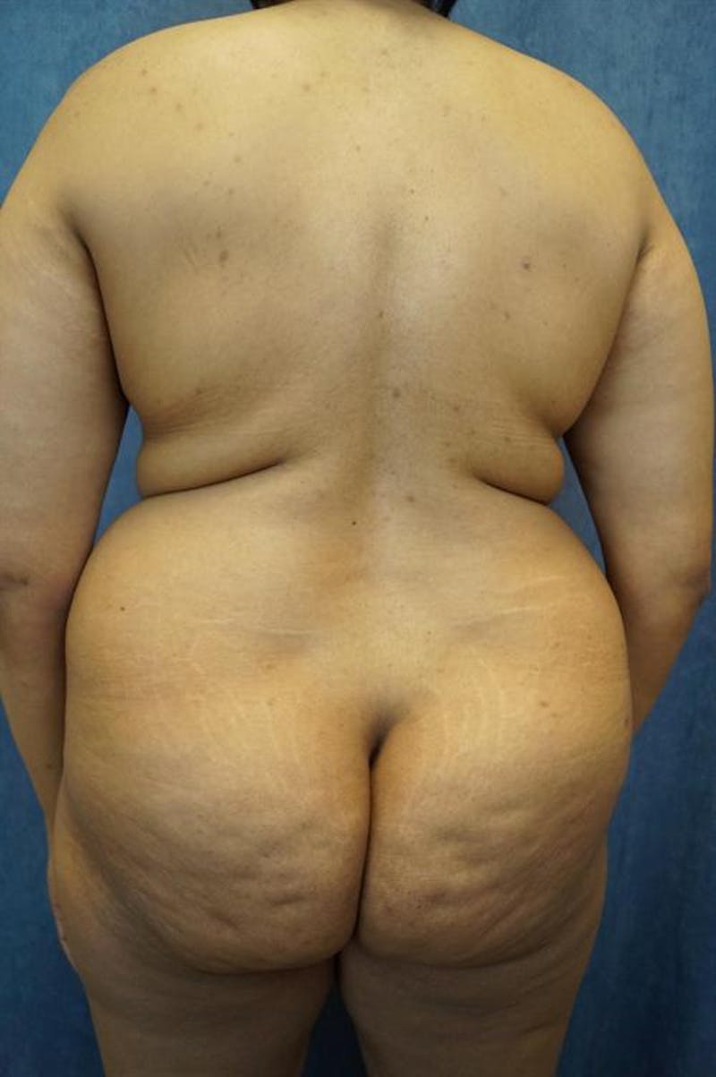 Liposuction Before & After Gallery - Patient 161229 - Image 1