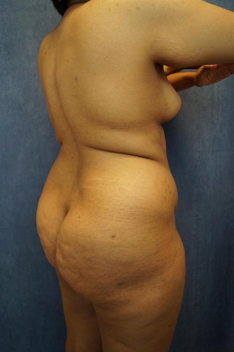 Liposuction Before & After Gallery - Patient 161229 - Image 3