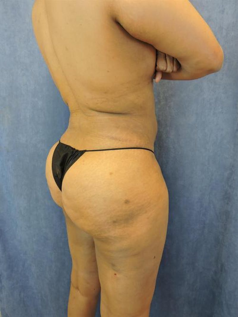 Liposuction Before & After Gallery - Patient 161229 - Image 4