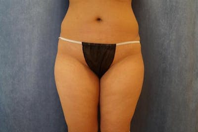 Liposuction Before & After Gallery - Patient 538343 - Image 1