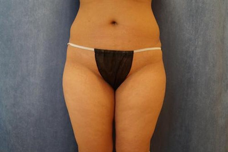 Liposuction Before & After Gallery - Patient 538343 - Image 1