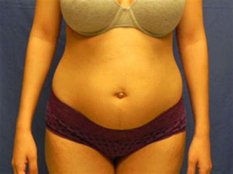 Liposuction Before & After Gallery - Patient 188698 - Image 1